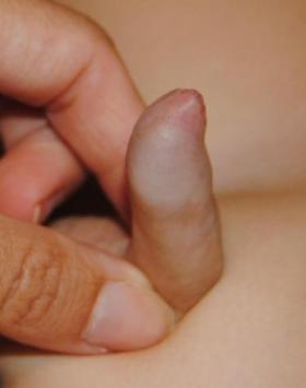Figura 1. Fimosis fisiológica en niño de 2 años