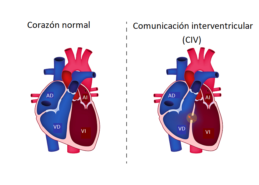 Mi Hijo Tiene Una Comunicaci N Interventricular Y Ahora Qu Familia Y Salud